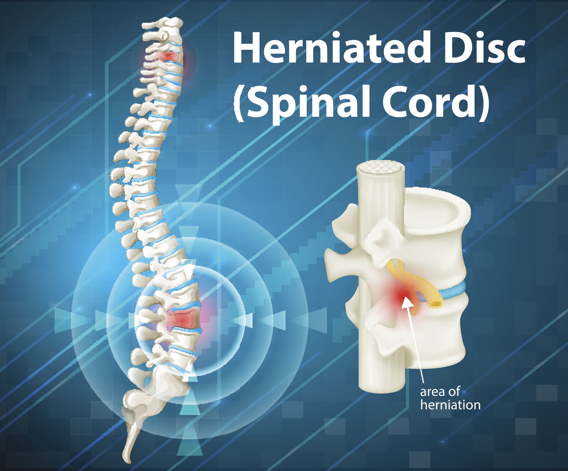 Herniated Disc Symptoms