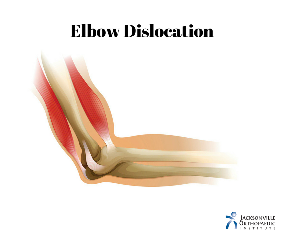 Elbow Dislocation